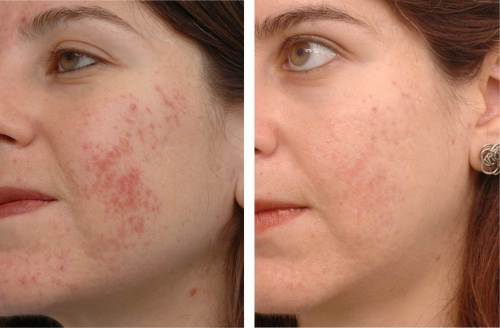 Dermapen Acne Treatment Before and After